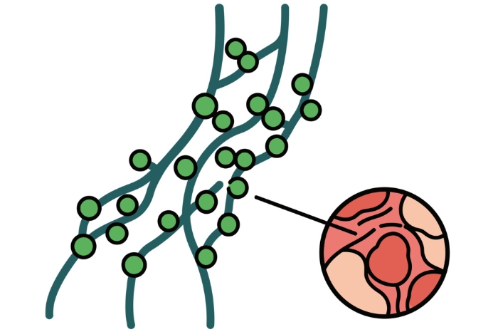 肢体莫名肿胀、皮肤变硬？要警惕淋巴水肿！一文读懂成因、治疗及预防手段→